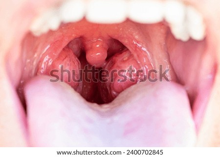 Closeup view of open mouth with tonsils. The child is a patient with large red glands. Tonsils in close-up in the mouth.