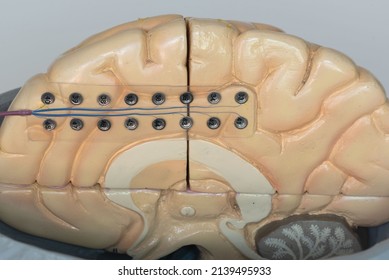 Close-up view of subdural electrode for recording brain waves or electroencephalography on medial surface of cerebral hemisphere.