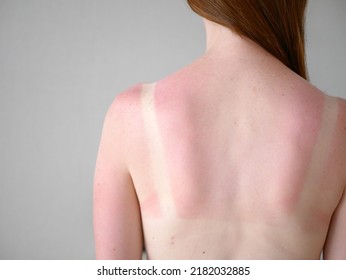 Close-up view of sunburn marks woman's back. Woman with reddened itchy skin after sunburn. - Shutterstock ID 2182032885