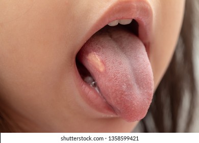 A Closeup View Of A Young Girl Sticking Her Tongue Out To Show A Mouth Ulcer On The Surface.