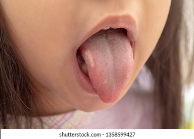 A Closeup View Of A Young Girl Sticking Her Tongue Out To Show A Mouth Ulcer On The Surface.