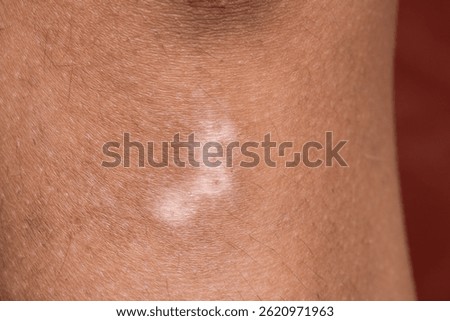 Close-up of vitiligo, a skin condition causing depigmentation, resulting in white patches on human skin
