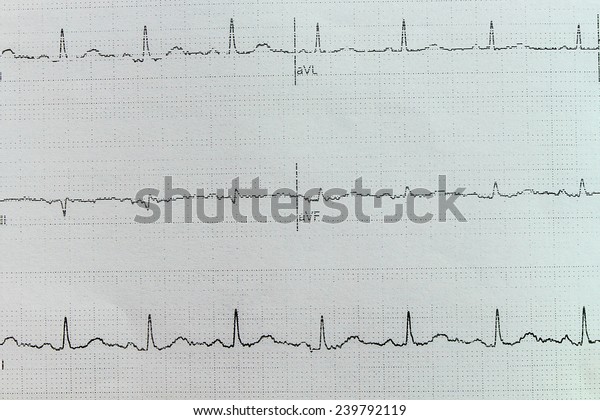 Closeup White Ecg Paper Normal Sinus Stock Photo 239792119 | Shutterstock