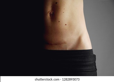 Closeup Of Woman Belly With A Scar From A Cesarean Section