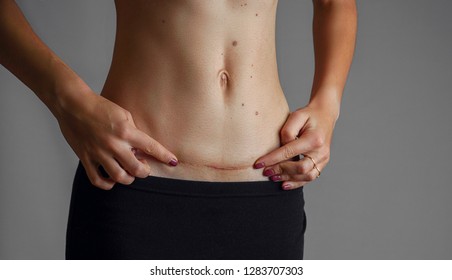 Closeup of woman belly with a scar from a cesarean section size
