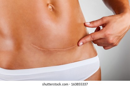 Closeup of woman belly with a scar from a cesarean section - Shutterstock ID 163855337