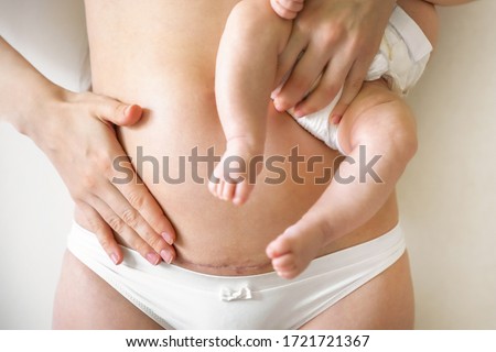 Closeup of woman belly with a scar from a cesarean section. Woman with baby on her hand