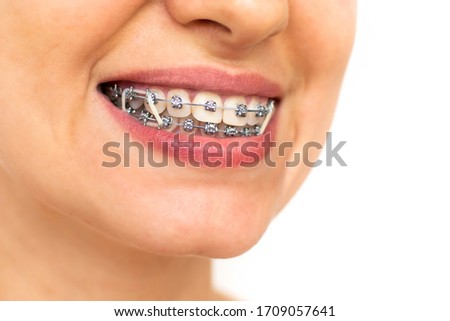 Closeup of woman with braces on teeth with elastics. Smiling face with braces isolated on white background. Orthodontic treatment. Closeup of healthy female mouth with metal braces. 