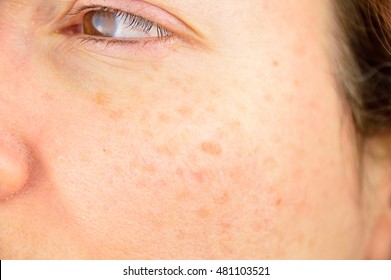 Closeup Of A Woman Cheek With Liver Spot Causes By The Large Exposition Sun 