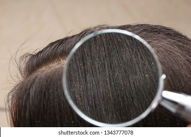 1,931 Illness Dandruff Images, Stock Photos & Vectors | Shutterstock