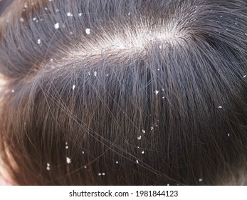 Closeup Woman With Dandruff In Her Hair.  Problem Health Care Concept. 