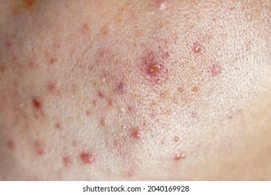 Closeup Of Woman Face With Bad Skin And Red Acne.