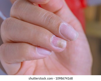Nail Infection Images Stock Photos Vectors Shutterstock