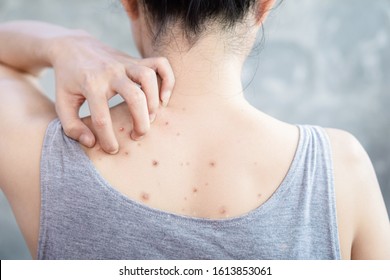 Closeup Woman Hand Scratching Her Skin Itchy Because Of Acne , Having Problem Dark And Red Spots On Back