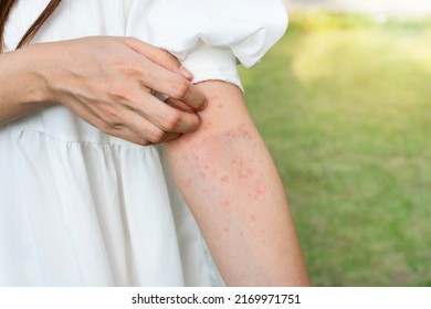 Closeup Of Woman Hand Scratching Her Skin Itchy. Allergic Rash Dermatitis Eczema Skin, Insect, Food Allergy, Health Care Concept