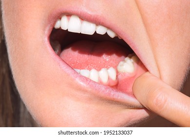 Closeup Of Woman Mouth Without Tooth On Lower Jaw. Missing Tooth, No Tooth. Woman After Tooth Extraction