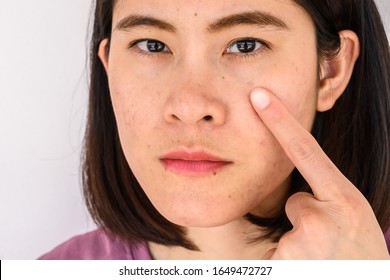 Close-up Of Woman Pointing A Problem On Her Face With Variety Problems On Her Skin (such As Acne, Pimple, Pores And Melasma Etc). Conceptual Of Natural Problem On Woman Skin.