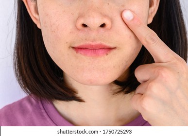 Close-up Of Woman Pointing A Problem On Her Face With Variety Problems On Her Skin (such As Acne, Pimple, Pores And Melasma Etc). Conceptual Of Natural Problem On Woman Skin.