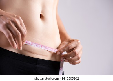 Closeup of woman showing on her belly dark scar from a cesarean section with measuring tape. Healthcare concept.