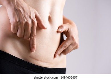 Closeup of woman showing on her belly dark scar from a cesarean section. Healthcare concept. - Shutterstock ID 1494638657
