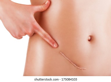 Closeup of woman showing on your stomach with a scar. Isolated on white background