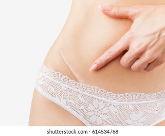 Closeup of woman showing on your stomach with a scar. Isolated on white background