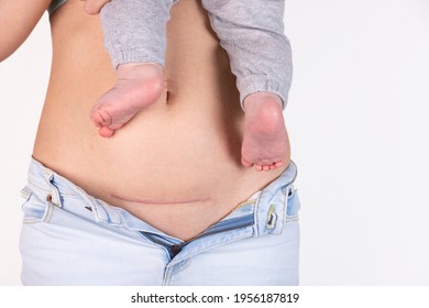 Close-up of a woman's belly with a cesarean section scar, five months after giving birth. Woman with a baby on her hand