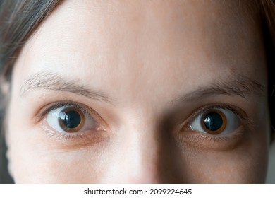 Close-up of a woman's brown eyes with dilated big pupils. Eye drops after a visit to an ophthalmologist. Concept of healthy vision. Ophthalmological examination and treatment.