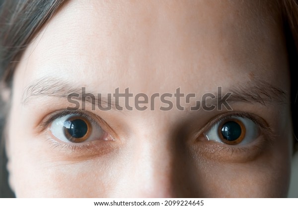 Close-up of a\
woman\'s brown eyes with dilated big pupils. Eye drops after a visit\
to an ophthalmologist. Concept of healthy vision. Ophthalmological\
examination and\
treatment.