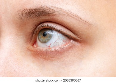 Close-up Of Woman's Eye With Red Inflamed And Dilated Capillaries. Hemorrhage Under The Conjunctiva. Disease Of Retina Of The Eye. Conjunctivitis, Keratitis, Dry Eye Syndrome, Trauma, Uveitis