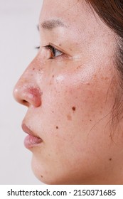 Close-up Of A Woman's Face, Half Face Portrait With Blemish Large Pores Black Dots Care For Problem Freckle Skin 