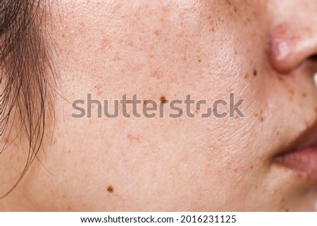 close-up of woman's face with large pores black dots and freckles on the surface of the face