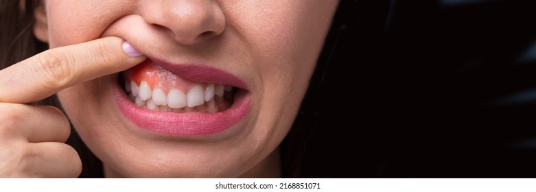 Close-up Of A Woman's Finger Showing Swelling Of Her Gum