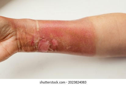 Close-up Of A Woman's Hand With A Burned Skin Of Boiling Water. Burn Treatment Theme. Red Dead Skin Of The Hands After A Thermal Burn. Selective Focus