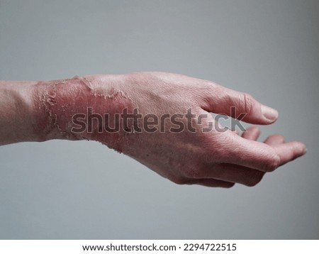 Close-up of a woman's hand with a burst blister from a boiled water burn, broken skin, 1st or 2nd degree burn. Painful wound. Thermal burn. Skin peels off after a burn, wound treatment. macro photo.