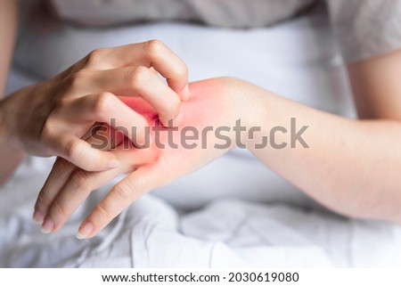 Close-up woman's hand scratching red rash on back of hand due to body allergy or insect bite
