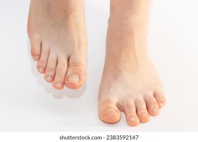 Close-up of woman's legs with flaky skin on toes. White background. Concept of pedicure and cosmetology.