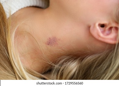 Close-up Of Womans Neck With Small Bruise. Blue And Red Colour Mark On Female Skin. Hickey Or Love Bite. Domestic Violence Or Simple Body Injury Concept