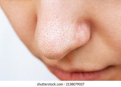 Close-up of a woman's nose with black heads or black dots isolated on a white background. Acne problem, comedones. Enlarged pores on a face. Cosmetology dermatology concept. Blackheads on greasy skin