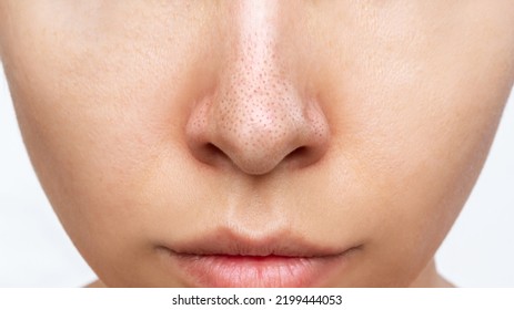 Close-up of woman's nose with black heads or black dots isolated on a white background. Acne problem, comedones. Enlarged pores on the face. Blackheads on greasy skin - Shutterstock ID 2199444053