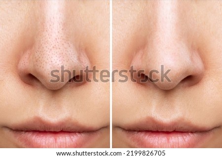 Close-up of woman's nose with blackheads before and after peeling, cleansing the face isolated on a white background. Acne problem, comedones. The result of getting rid of black dots
