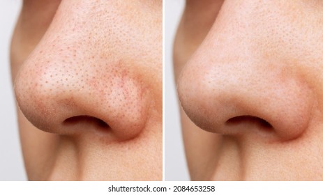 Close-up of woman's nose with blackheads or black dots before and after peeling and cleansing the face isolated on a white background. Acne problem, comedones. Cosmetology dermatology concept - Shutterstock ID 2084653258