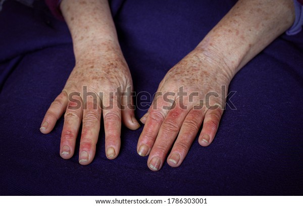 Closeup Womans Reddened Hands Wounds Raynauds Stock Photo 1786303001 ...