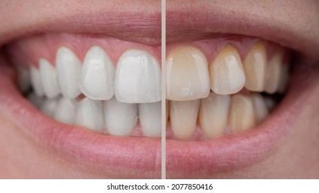 1,739 Orthodontics before and after Images, Stock Photos & Vectors ...