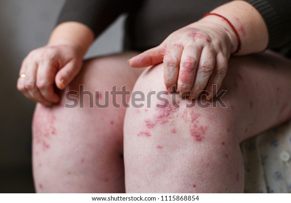 かゆみ 乾癬の斑点を手で掻く女性の接写 皮膚に対する乾癬や湿疹 赤い斑点を持つアトピー性アレルギーの皮膚 の写真素材 今すぐ編集