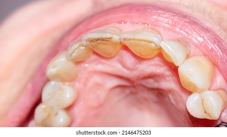Close-up of a worn and fractured dentition of an elderly lady. Upper arch of teeth with severe lesions of the enamel, crown and collar.