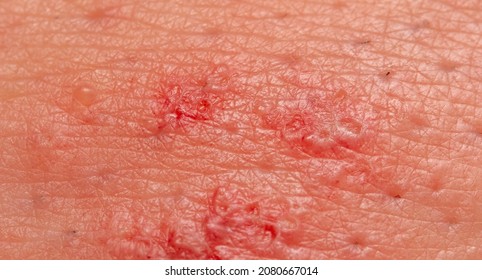 Close-up Of A Wound With Pus On Human Skin. Macro