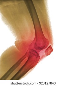 Close-up xray of a human knee isolated on back background , side view