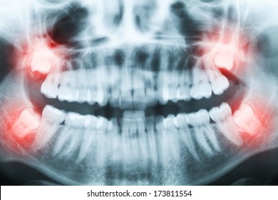 Closeup of x-ray image of teeth and mouth with all four molars vertically impacted. Filled cavities visible. Impacted wisdom teeth (number 8) on the right side of the face (image left) shown red. - Shutterstock ID 173811554