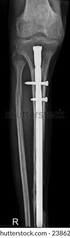 Close-up X-ray of a tibia fracture after successful intramedullary nail fixation.